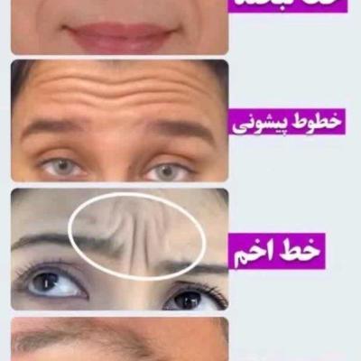 از بین بردن چروک های قوی